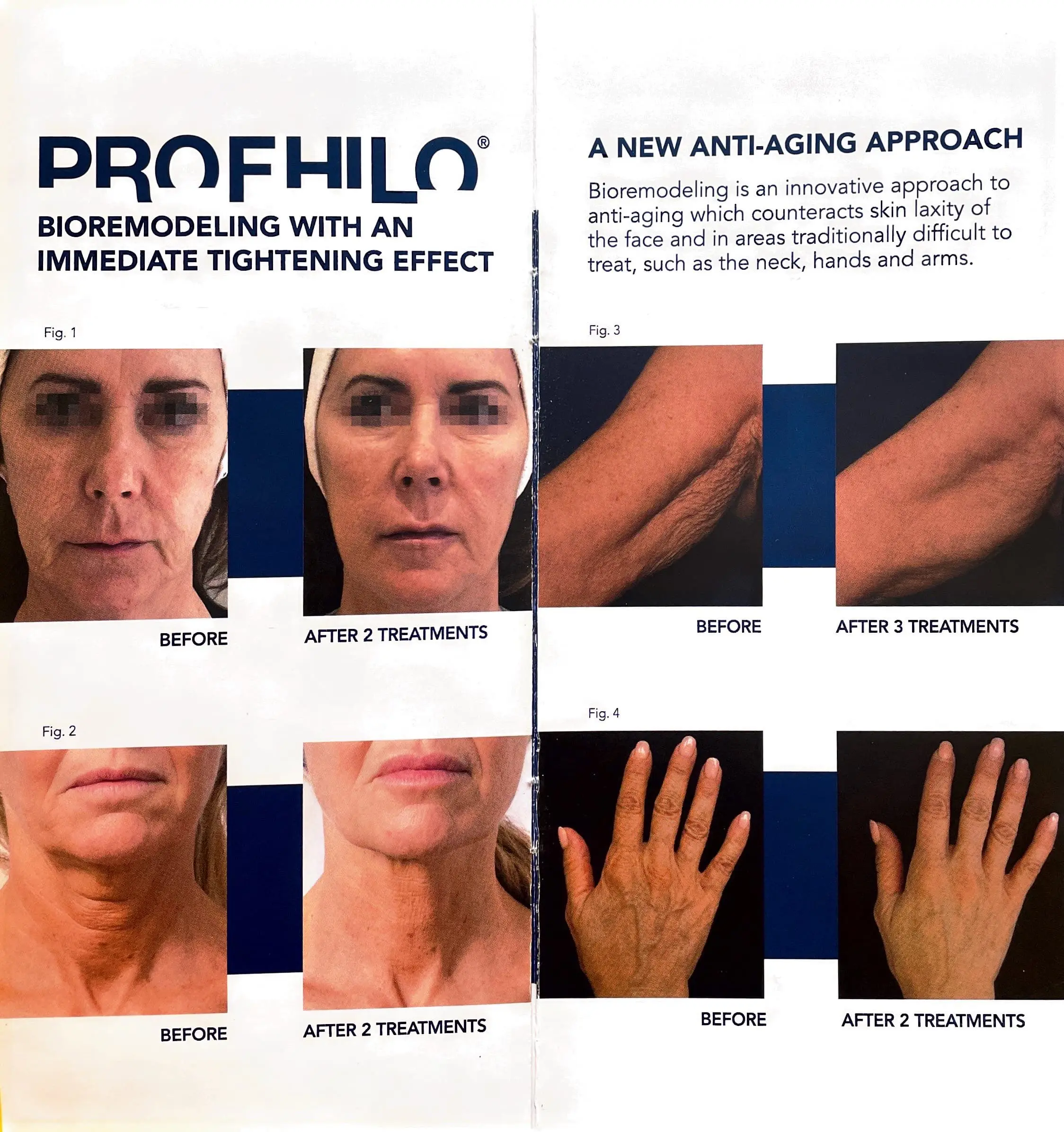 Hyaluron-prohfilo Behandlung